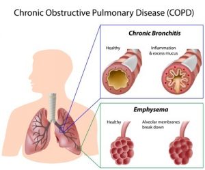 Smoke and the burnout of muscles: How does smoking cause COPD?