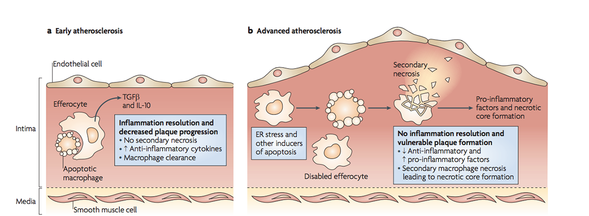 Advancement plaques 1.16 5. Inflammation atherosclerosis. Atherosclerosis macrophage. Inflammation Cell.