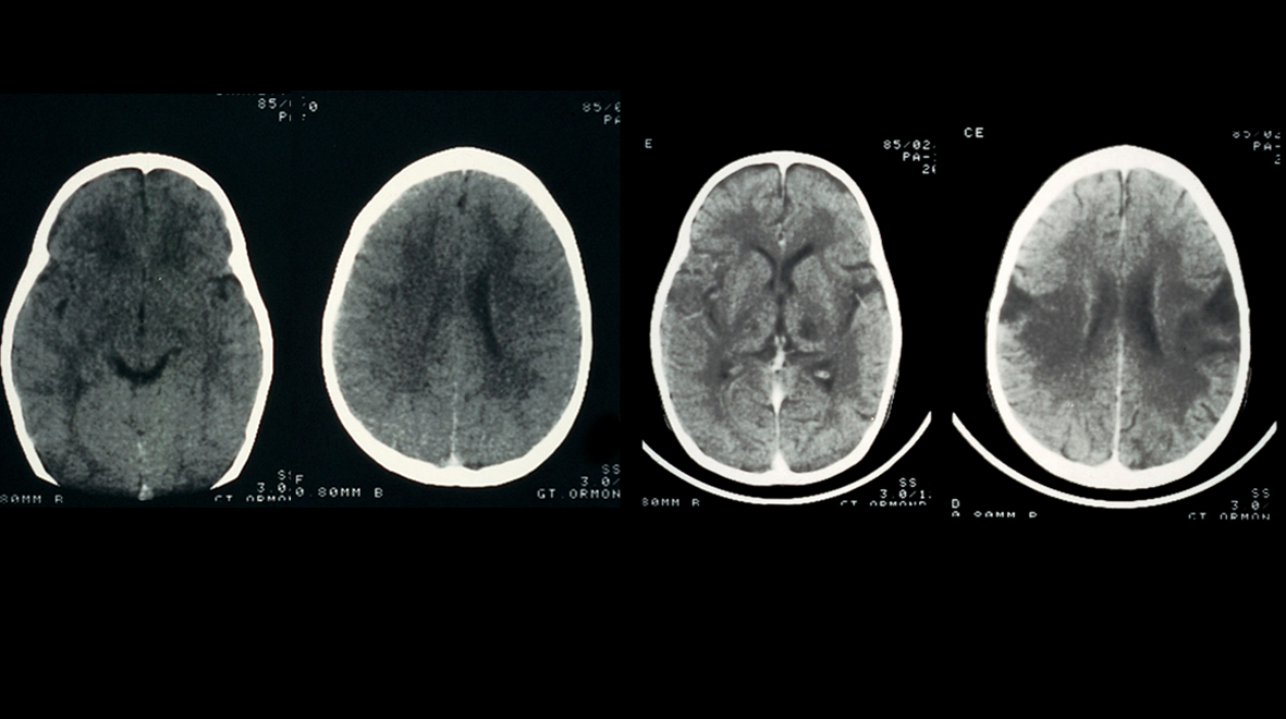 Encephalitis: the rare disease with a million implications