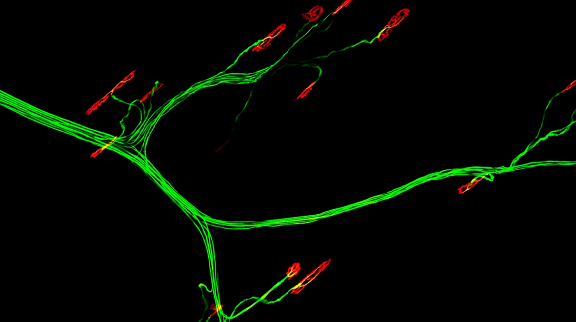 Challenges in Motor Neurone Disease: from ice buckets to new therapeutic targets