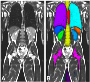 artificial intelligence bone disease